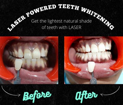 Get Professional Results at Home with Magic Teeth Whitening